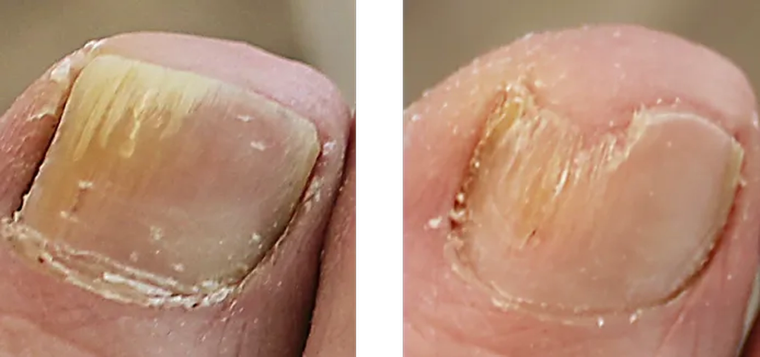 Fusszinierend - Fußpflege -Kundin (70 J.) mit Nagelpilz