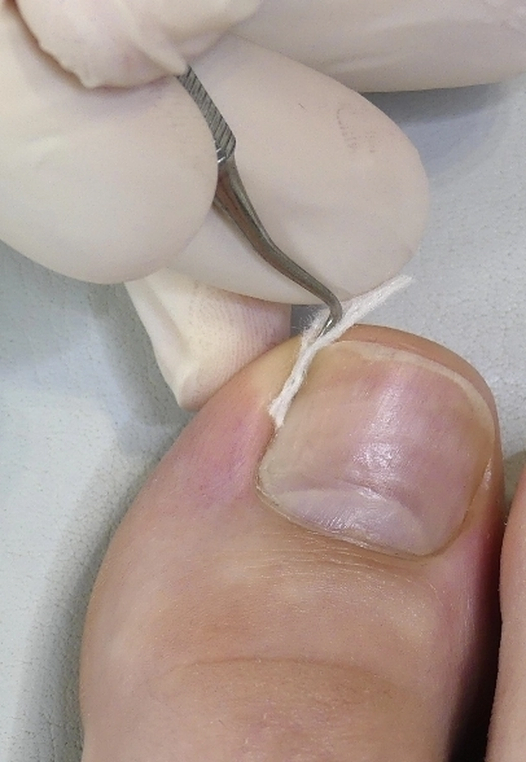 Fusszinierend - Fußpflege -Nagelfalztamponaden