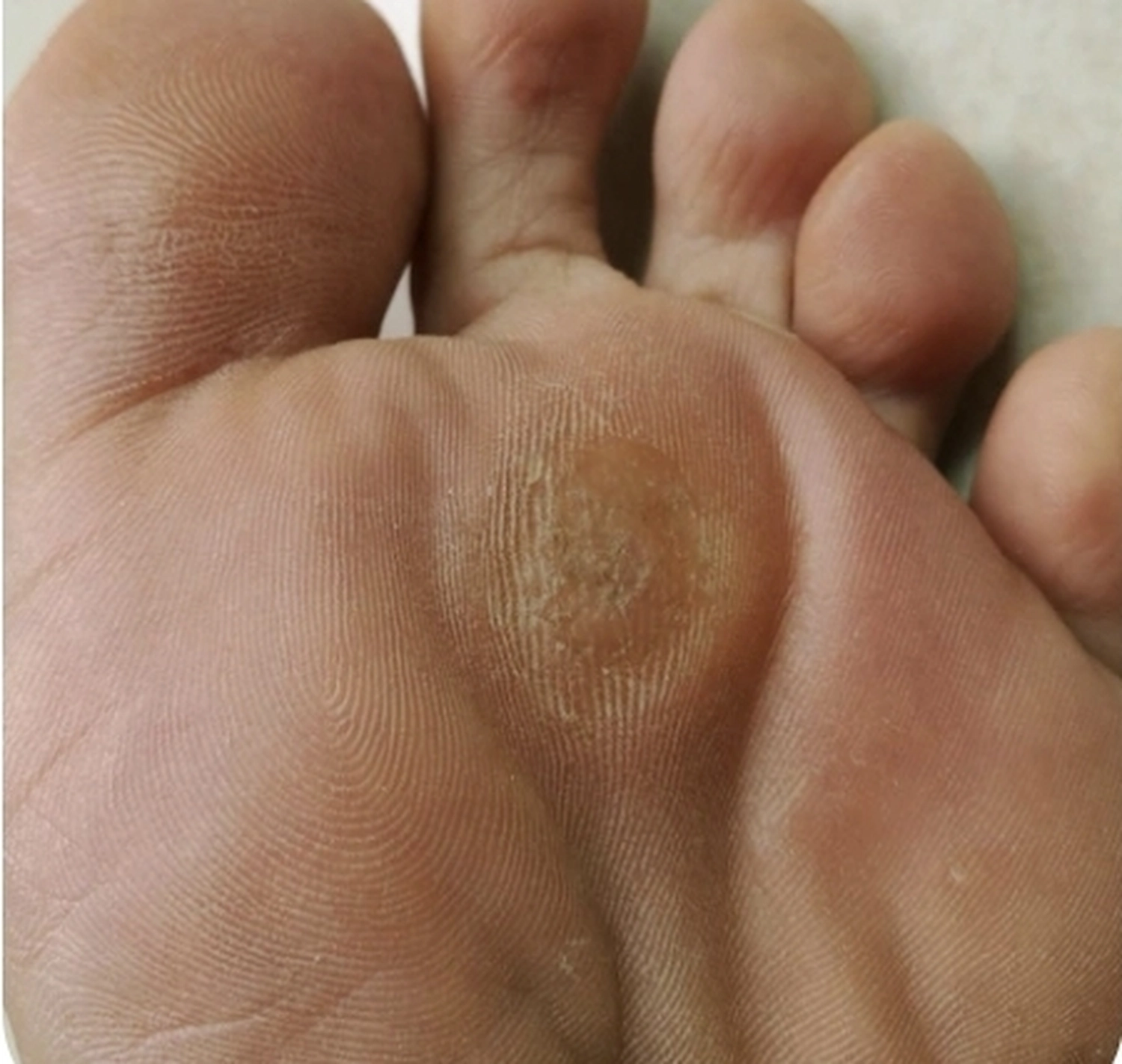 Fusszinierend - Fußpflege - Hornhaut, Hühneraugen und Schrunden