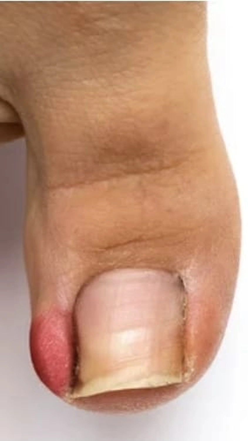 Fusszinierend - Fußpflege - Eingewachsenen Nägel, Ursachen, Behandlung und Tipps