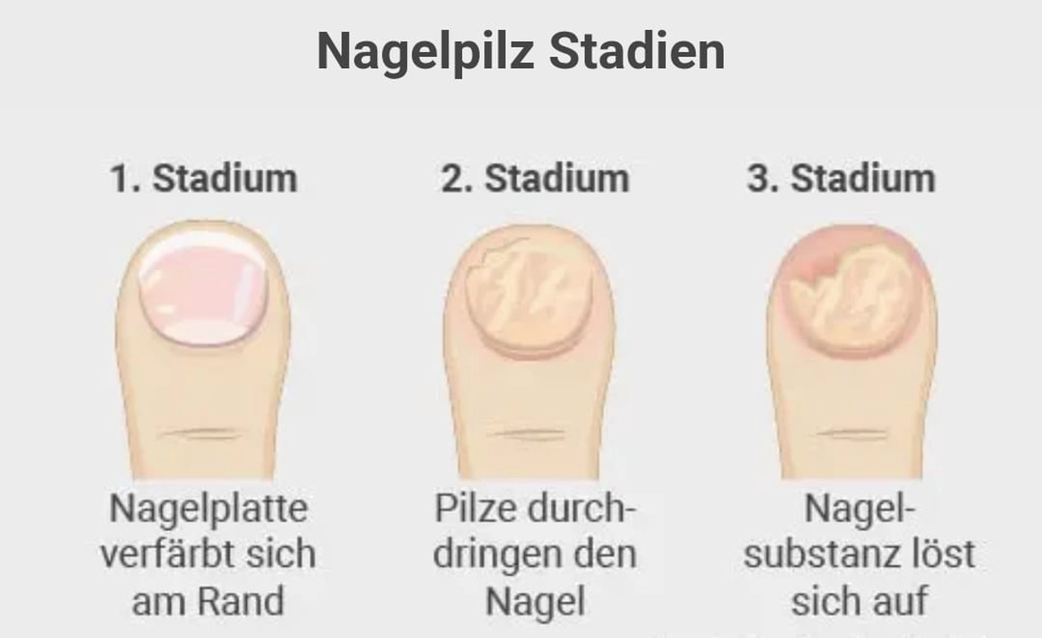 Fusszinierend - Fußpflege - Nagelpilz