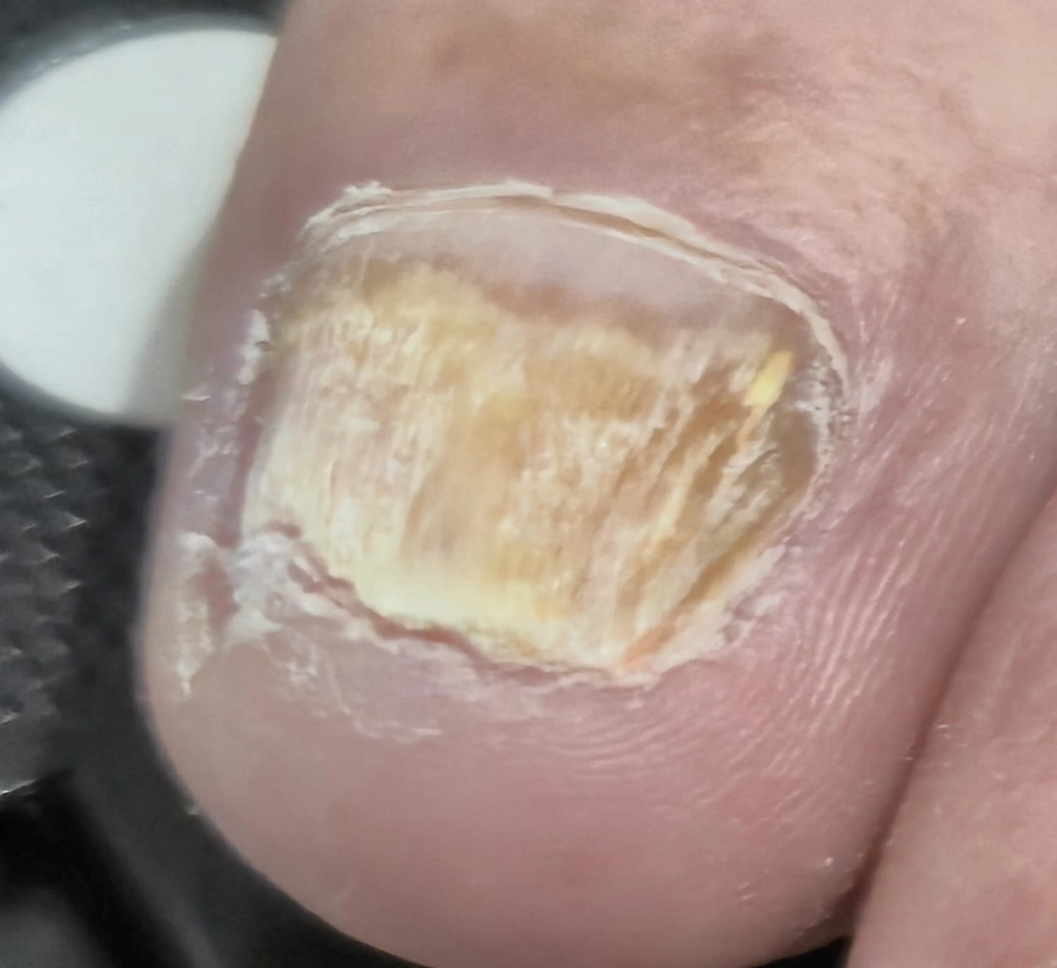 Fusszinierend - Fußpflege - Nagelpilz